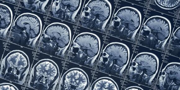 Brain scans reveal how a woman voluntarily enters a psychedelic-like ...