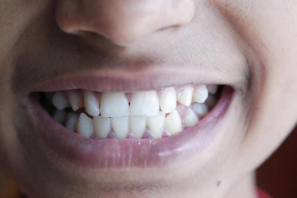 Why Your Teeth Chatter When You're Cold - NewsBreak