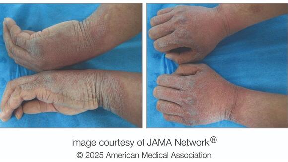 Diagnostic dilemma: A rare condition caused a man to get 'scales' on ...