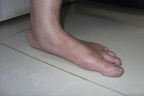 Why Your Feet Can Grow a Size Larger in Adulthood - NewsBreak