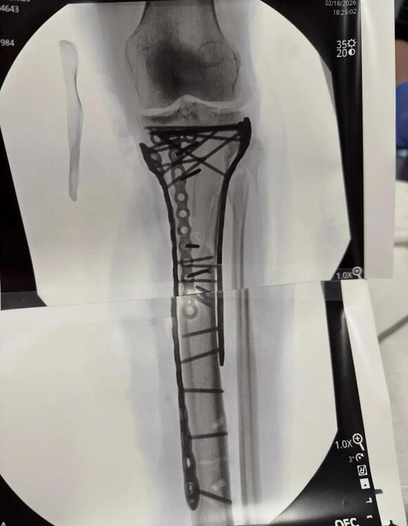 Lindsey Vonn Shares Images from 5th Surgery at Home in Colorado - NewsBreak
