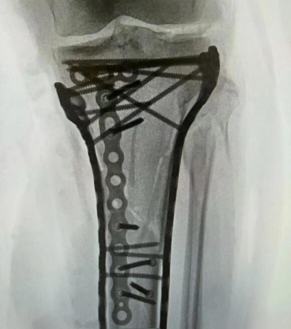 Lindsey Vonn Shares Images from 5th Surgery at Home in Colorado - NewsBreak
