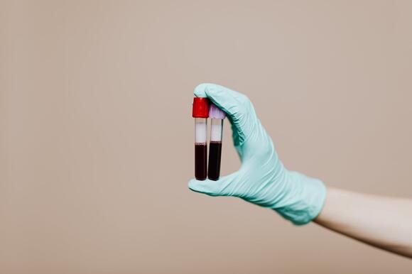 5 Lab Services Billed Separately Instead of Bundled - NewsBreak