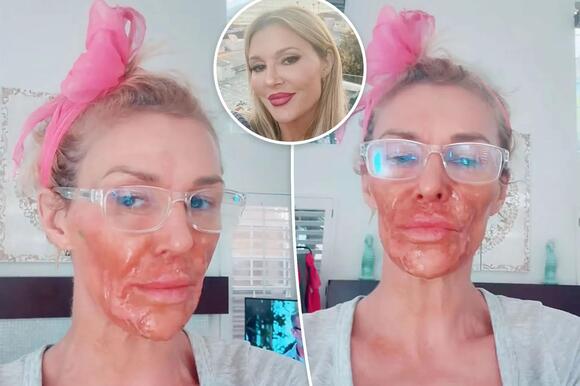 Brandi Glanville severely burns face in stupid attempt to kill facial  parasite - NewsBreak