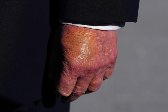 Trump, 80, Spotted With Mystery Face Bruise - NewsBreak
