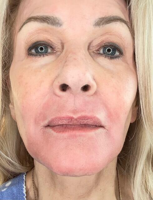 I’m 74, and This Needle-Free Treatment Makes Me Look Decades Younger ...