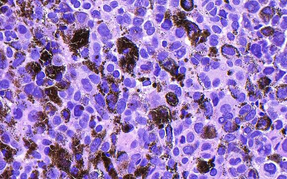 Personalized mRNA melanoma vaccine cuts recurrence risk by 42% in late-stage trial