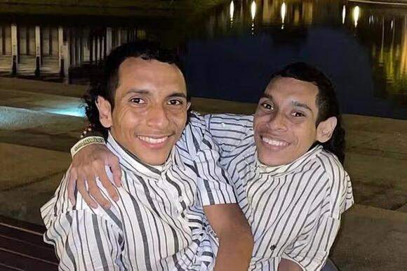 Conjoined twin influencers dead after unexpected 'heart attack’ on trip ...