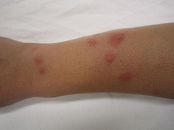 There are laws particular to bed bugs in 23 states: Missouri law ...