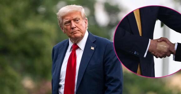 Donald Trump Seen With Makeup-Covered Bruised Hand Again After Chronic Venous Insufficiency Diagnosis - NewsBreak