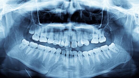 Prathab Muniandy, The Man With The Most Teeth On Earth, Only Realized ...