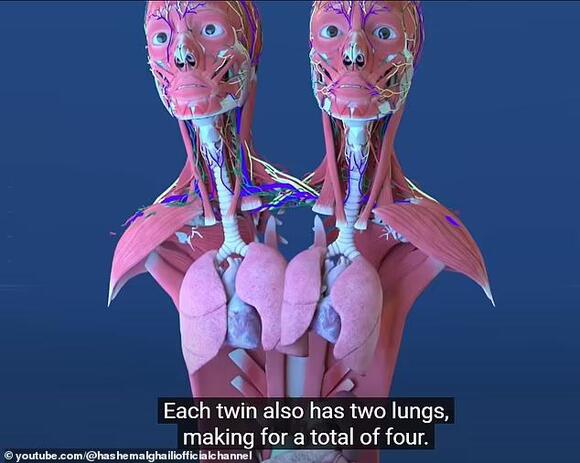 Fans left stunned as conjoined twins Abby and Brittany Hensel reveal ...