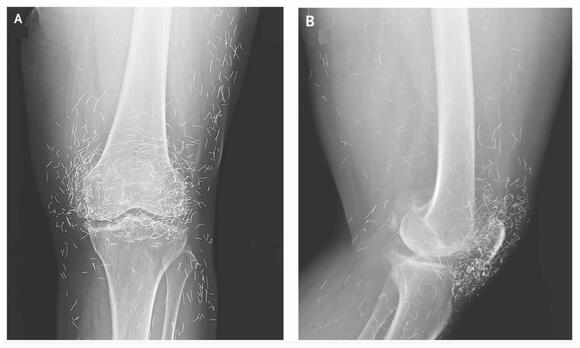 Woman’s knee pain was caused by gold threads in her joints left behind ...