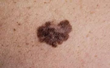 Experimental Melanoma Vaccine Is the Realization of a Long-Held ‘Dream’
