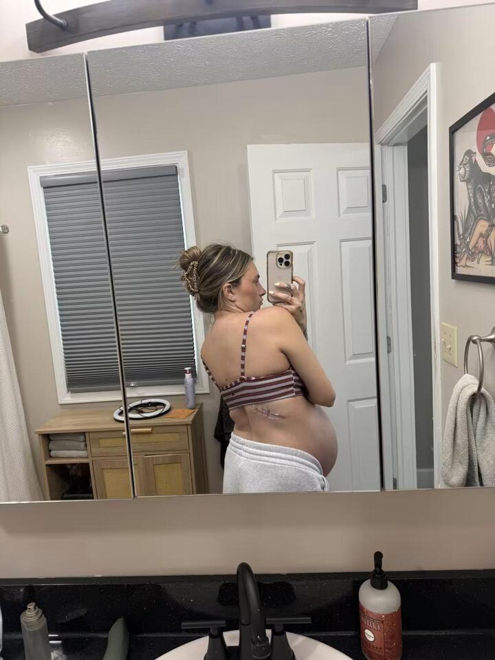 Mom, 33, Shocked By Melanoma Diagnosis While Pregnant: What Doctors Want Women to Know
