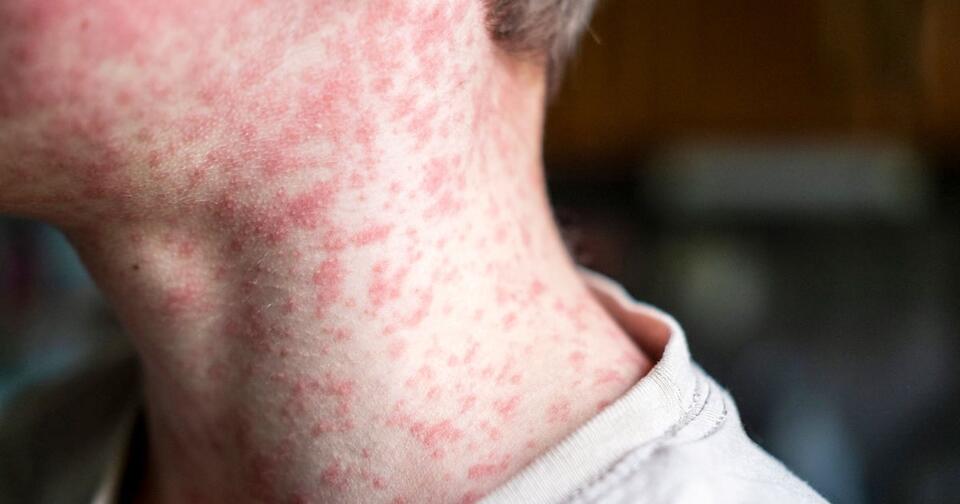 What happens when measles comes to your farm?
