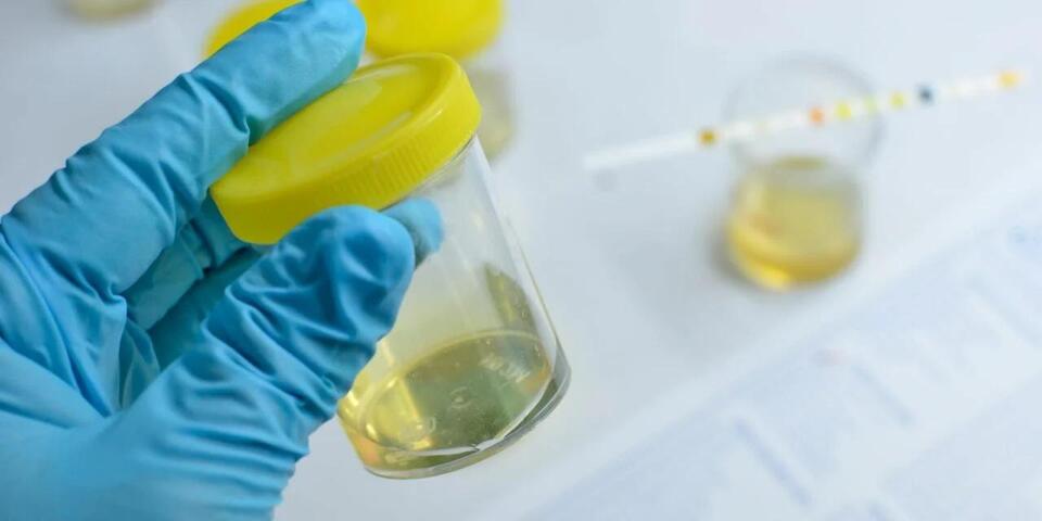Urine Cell-Free RNA Test Detects Bladder Cancer and Predicts Therapy ...