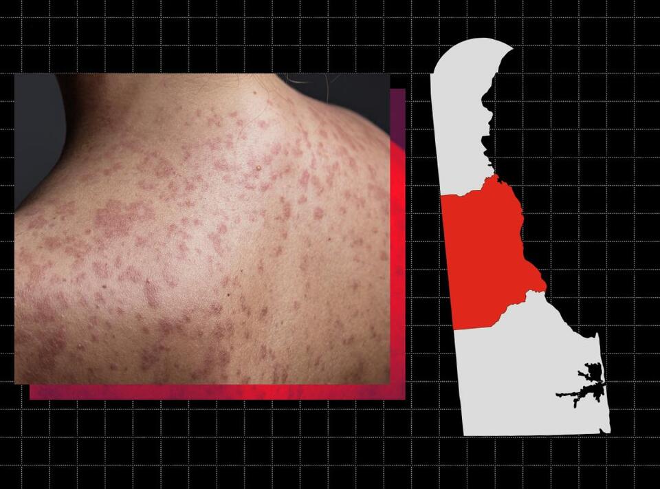 Delaware reaches 23 measles cases, still localized to Kent County ...