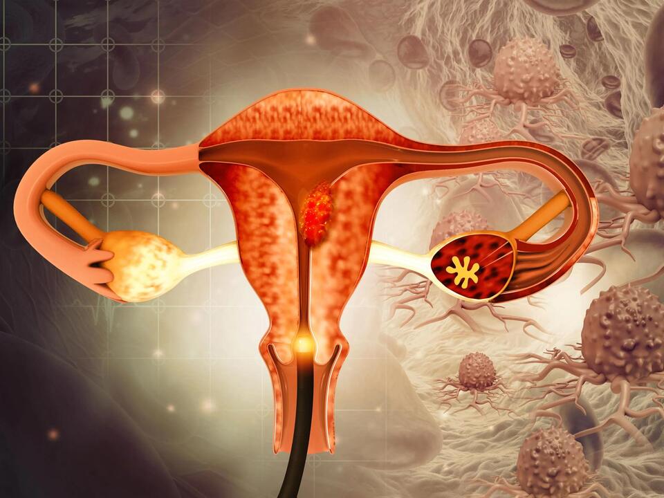Estrogen Therapy Alone Raises Ovarian/Endometrial Cancer Risk in