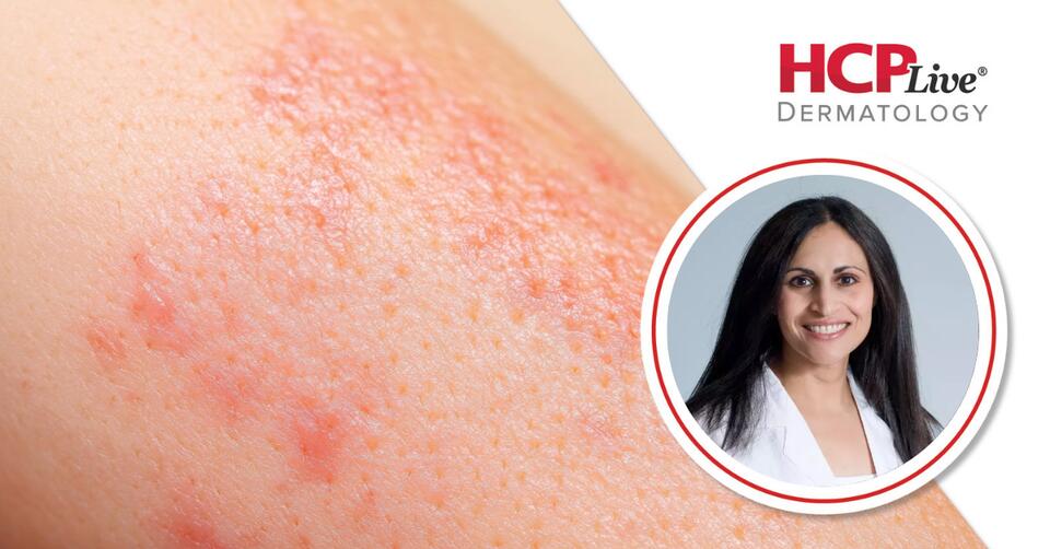 3-Year Nemolizumab Data in Atopic Dermatitis, With Sarina Elmariah, MD ...
