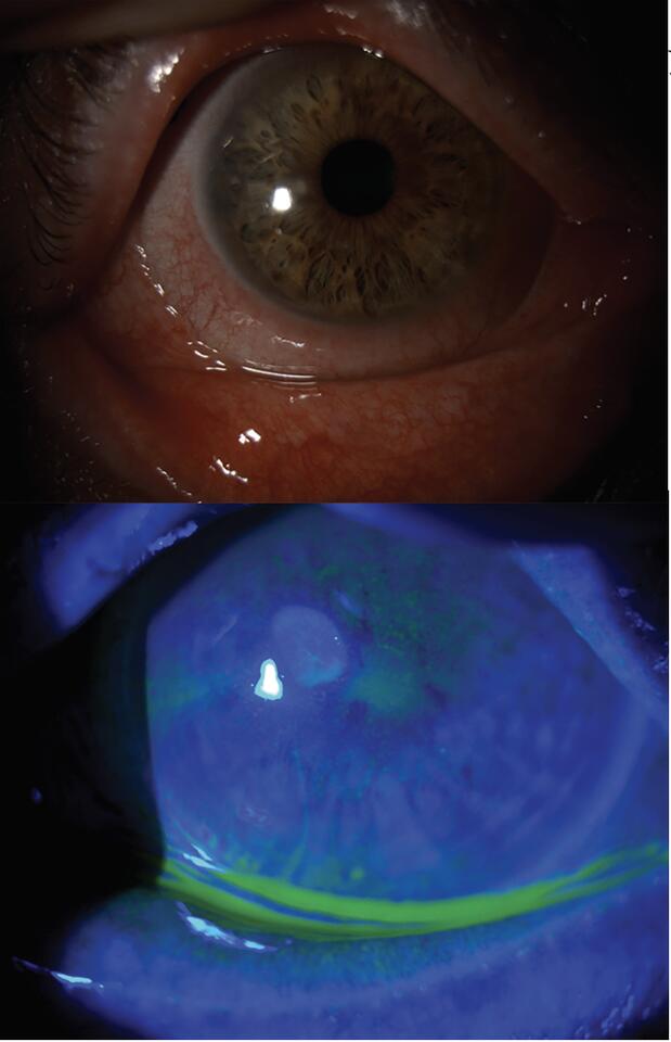 Beyond Inflammation: The Evolving Dry-Eye Pipeline - NewsBreak