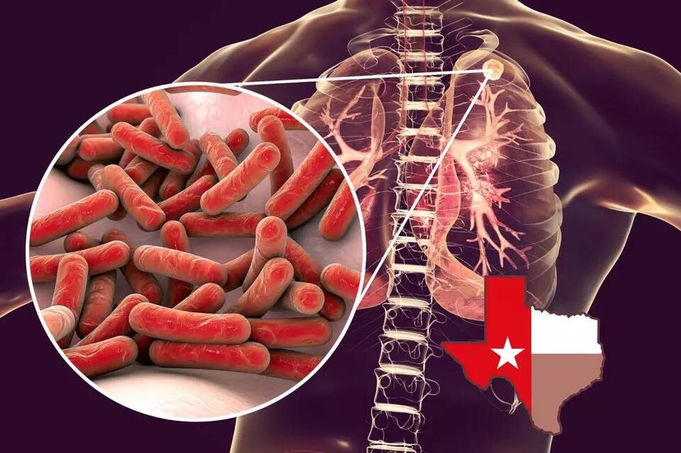 A Deadly ‘Old World’ Disease Is Becoming New Threat In Texas - NewsBreak