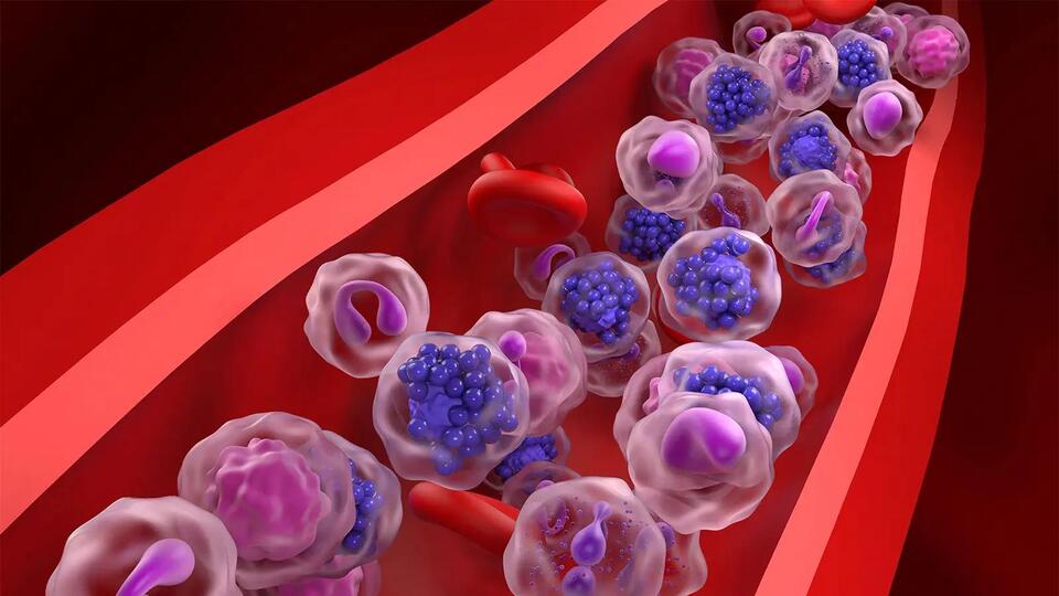 A Deep Dive Into Double-Hit Lymphoma - NewsBreak