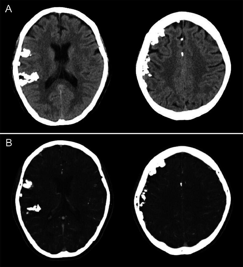 Multiple extra-axial calcified lesions and tortuous vessels in a ...