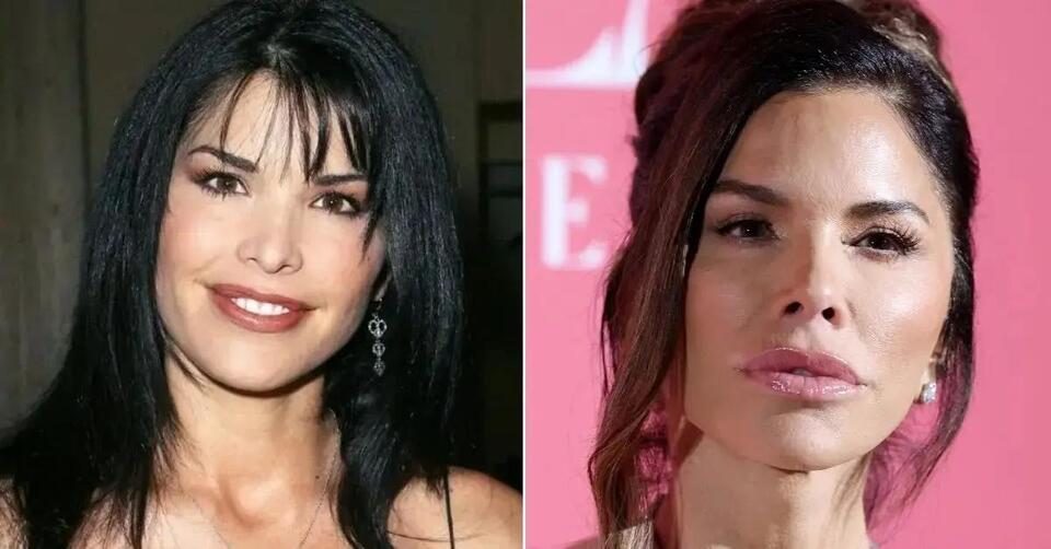 EXCLUSIVE Lauren Sánchez's 'Dramatic' Before and After 'Plastic(01)