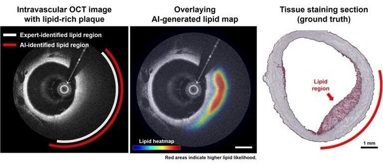 AI-Based OCT Image Analysis Identifies High-Risk Plaques in Coronary ...