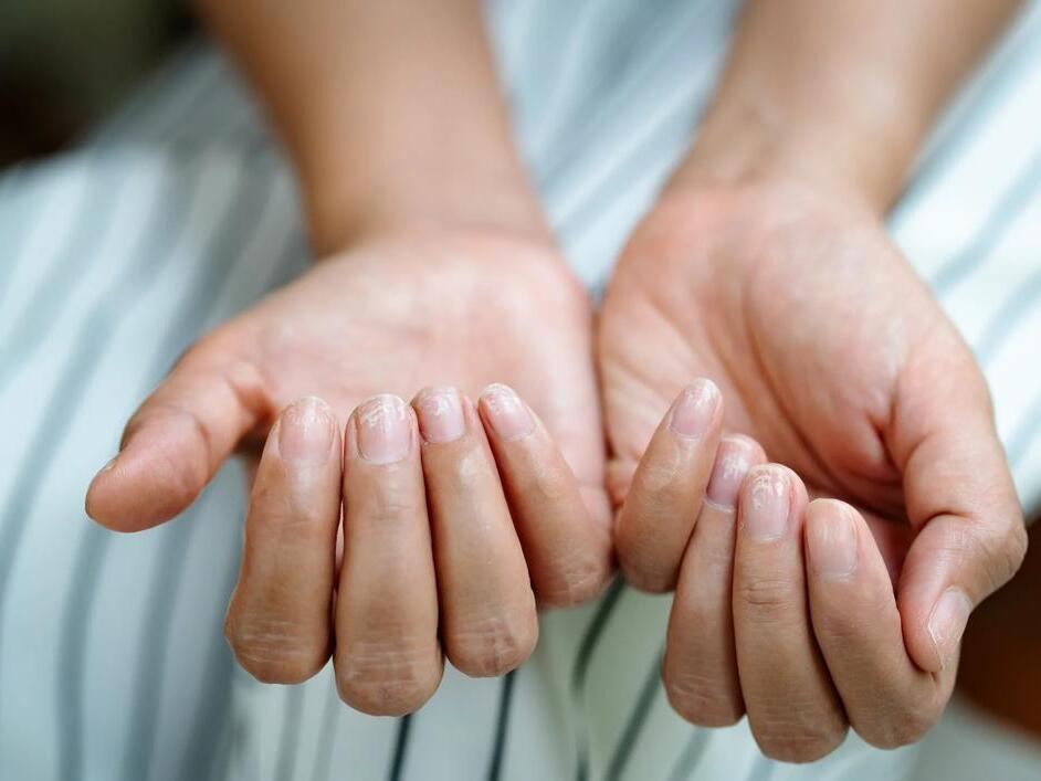 How Does Menopause Impact Nail Growth? Dermatologist Weighs In on