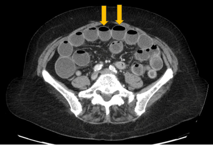 GLP-1 Receptor Agonists in Diabetes and Obesity: A Case Report and Review of Bowel Obstruction Risks and Management