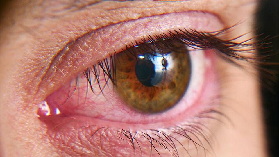 Innovent's Sycume Meets Phase 3 Goal in Inactive Thyroid Eye Disease ...