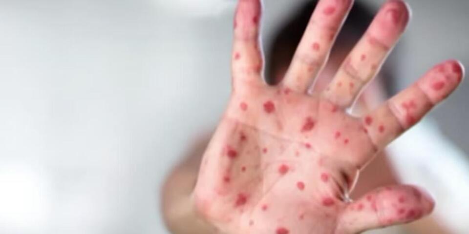 Tennessee health department confirms 4th cases of measles in 2026 ...