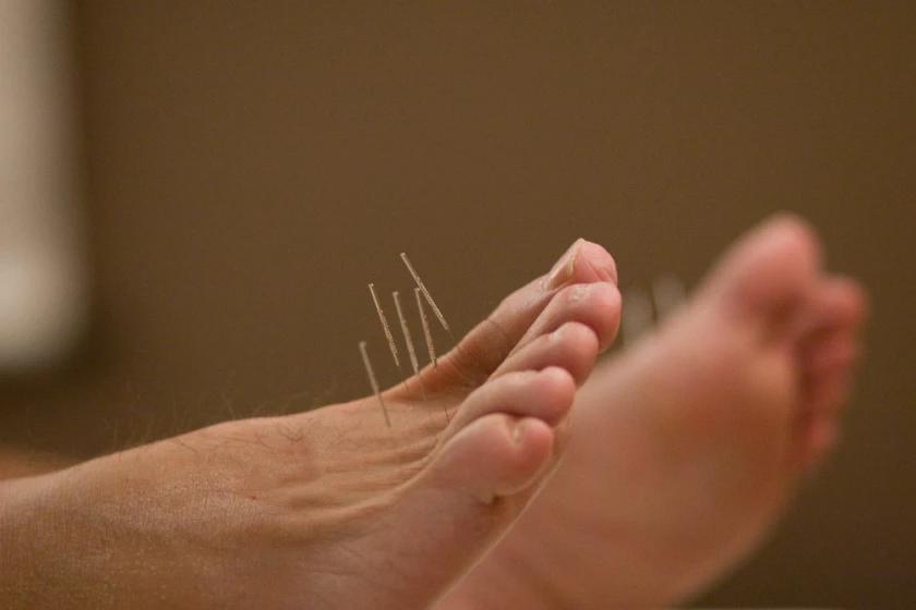 Could acupuncture be the missing piece to better health? Idaho experts weigh in