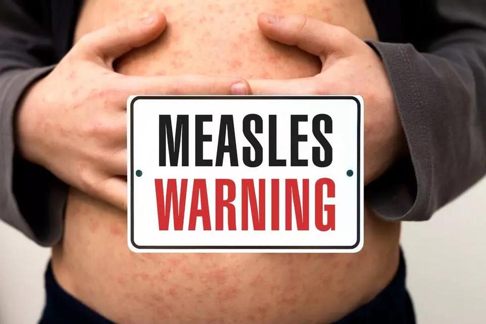 Measles Outbreak Spread Is Confirmed in Texas - NewsBreak