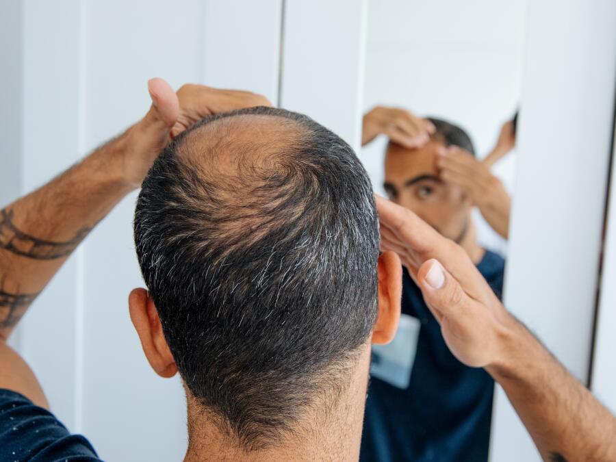 Balding and Itchy? The Best Shampoo to Fight Dandruff and Hair Loss Is