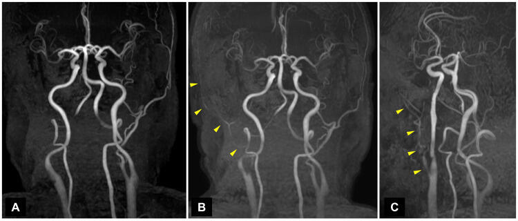 Jaw Claudication Caused by Atherothrombotic External Carotid Artery ...