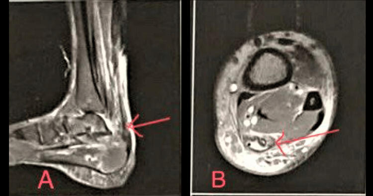 A Case of Chronic Rupture of Achilles Tendon Managed Using a Combination of Multiple Surgical Techniques
