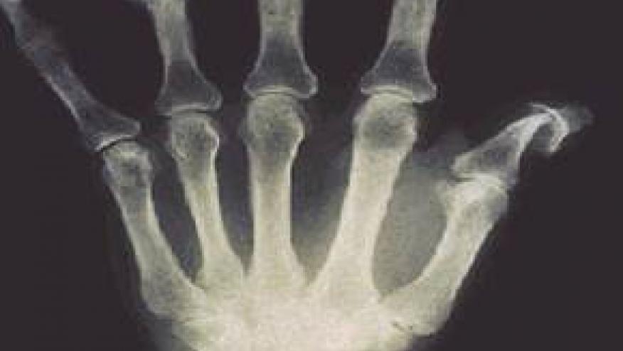 Guselkumab gets FDA Nod for X-ray Protection