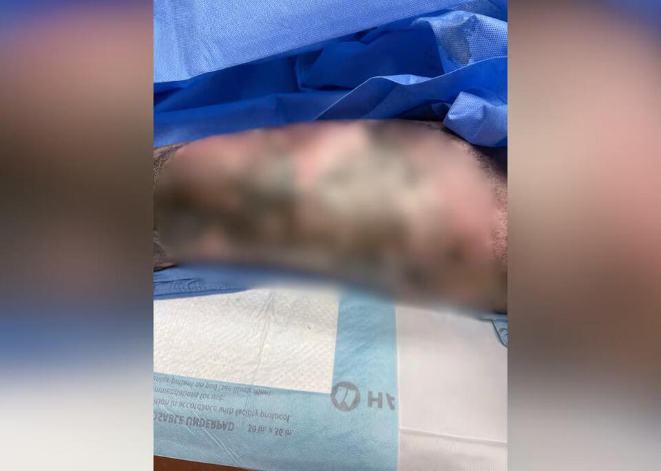 Exploding vape battery sends Salem man to ICU with severe burns, family ...