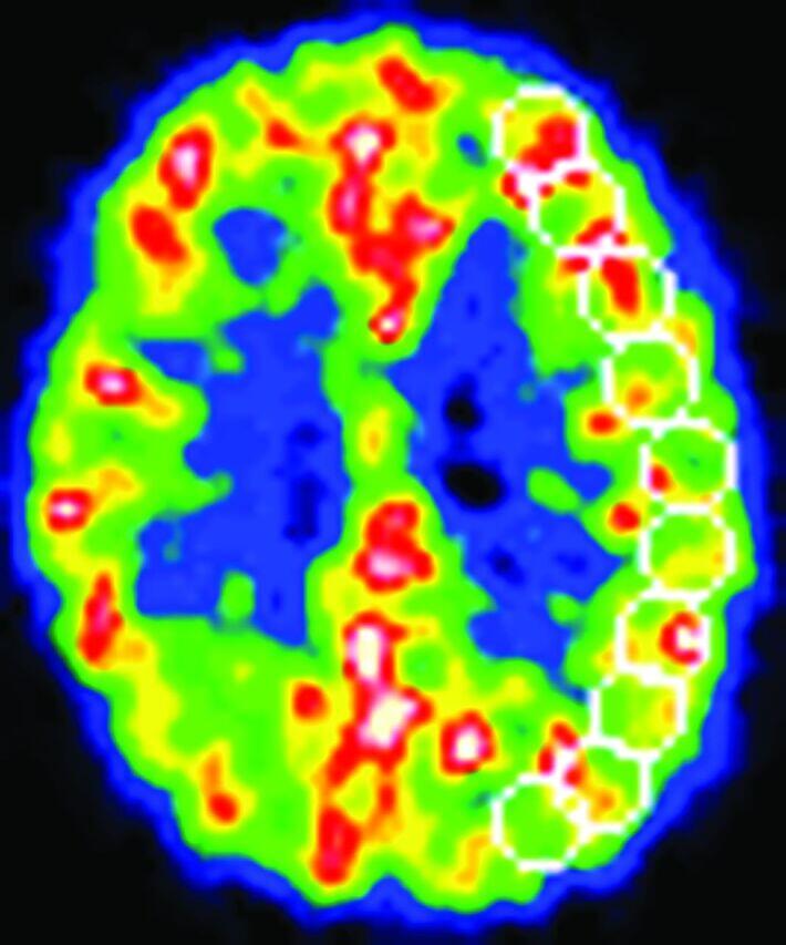 Chronic Hemodynamic Compromise and Cerebral Ischemic Events in ...
