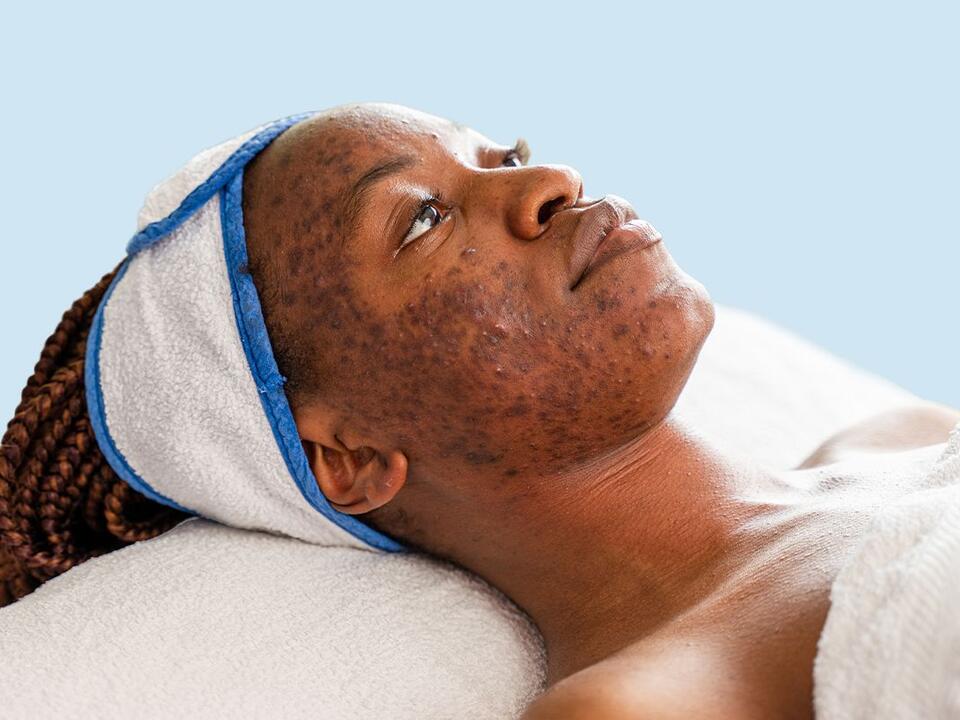 How Can I Get Rid of Severe Acne?