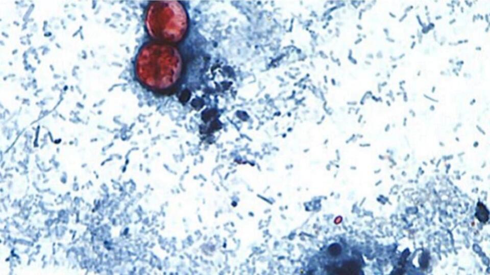 More than 11,500 cyclosporiasis cases reported in 41 states, CDC data shows