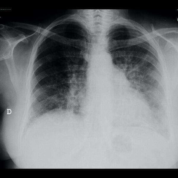 From the Heart to the Lung: A Case of Drug Toxicity - NewsBreak