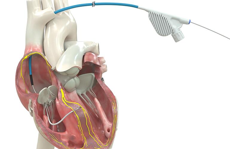 Medtronic nets CE mark for Vitalis family of conduction system ...