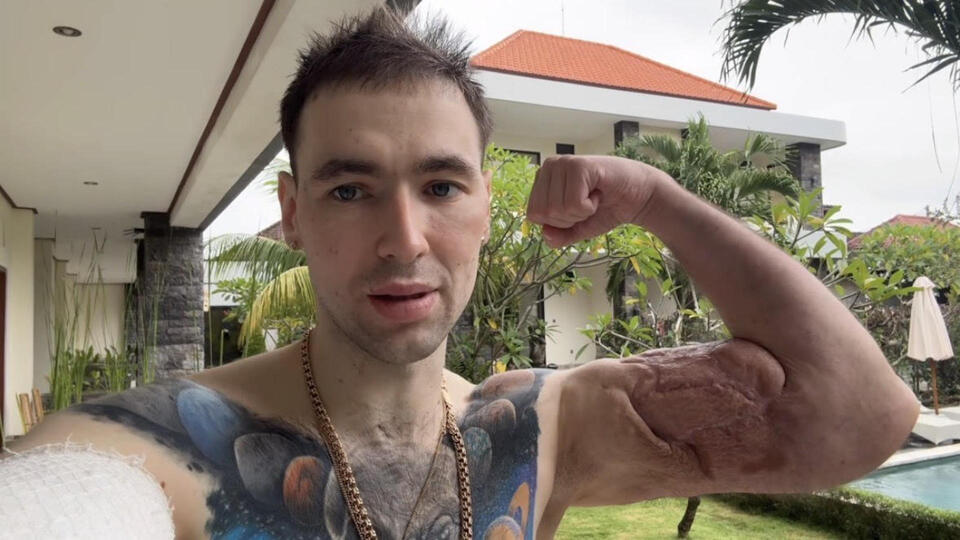 Russian ‘Popeye’ Kirill Tereshin Shares Status After Operation To Drain ...