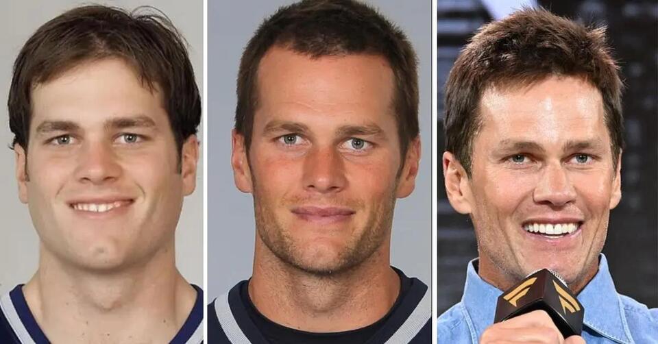 'Plastic Surgery Done Right' Tom Brady's Secret Nip Tuck to Remove