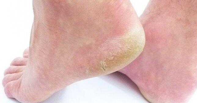 Dermatologist offers tips to prevent dry, cracked heels – NewsBreak