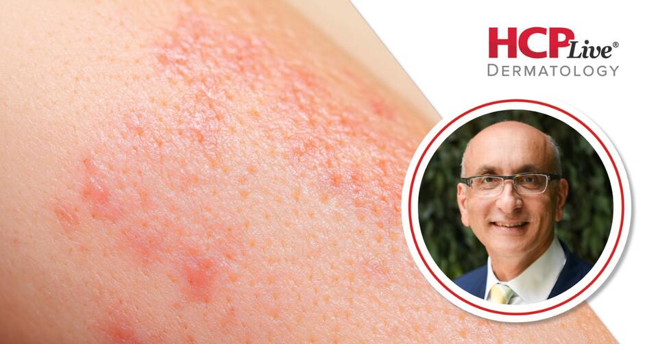 First-in-Class Oral ENV-294 Evaluated in Atopic Dermatitis, With Leon ...